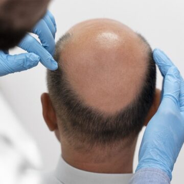Layers Which is the Best Hair Transplant Clinic in Hyderabad? What You Should Know Before Choosing a Clinic?