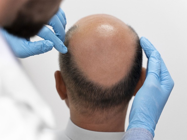 Layers Which is the Best Hair Transplant Clinic in Hyderabad? What You Should Know Before Choosing a Clinic?